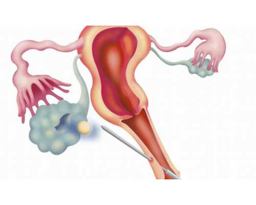 子宫肌瘤：揭示其症状、因及影响的神秘之旅